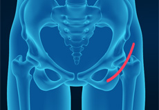 Anterior Total Hip Replacement