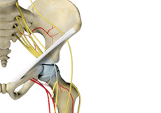 Avascular Necrosis of the Hip