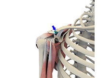 Distal Clavicle Excision