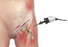 Hip Arthroscopy