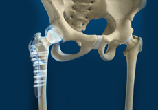 Hip Fracture Surgery