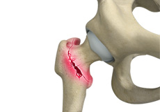 Hip Fracture