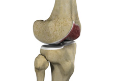 Knee Arthritis