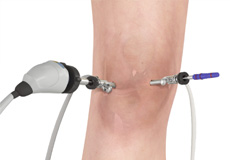 Knee Arthroscopy