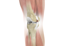 Knee Ligament Reconstruction