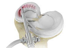 Meniscal Surgery