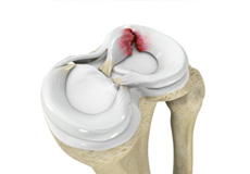 Meniscus Injury or Tear