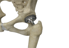 Painful Total Hip Replacement