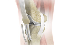 Patellar Tendon Repair