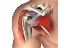 Proximal Biceps Tenodesis