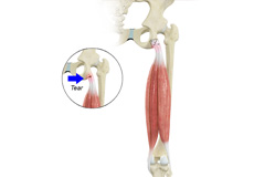 Proximal Hamstring Repair