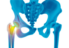 Revision Total Hip Replacement