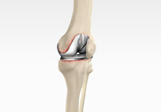 Revision Knee Replacement