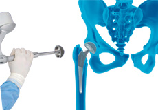 Robotic Assisted Total Hip Replacement