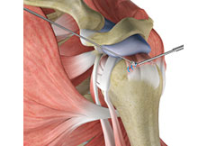 Rotator Cuff Repair