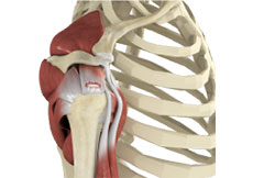 Rotator Cuff Injury or Tear