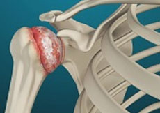Arthritis of the Shoulder