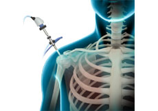 Shoulder Arthroscopy