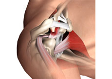 Subacromial Decompression