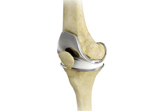 Total Knee Replacement